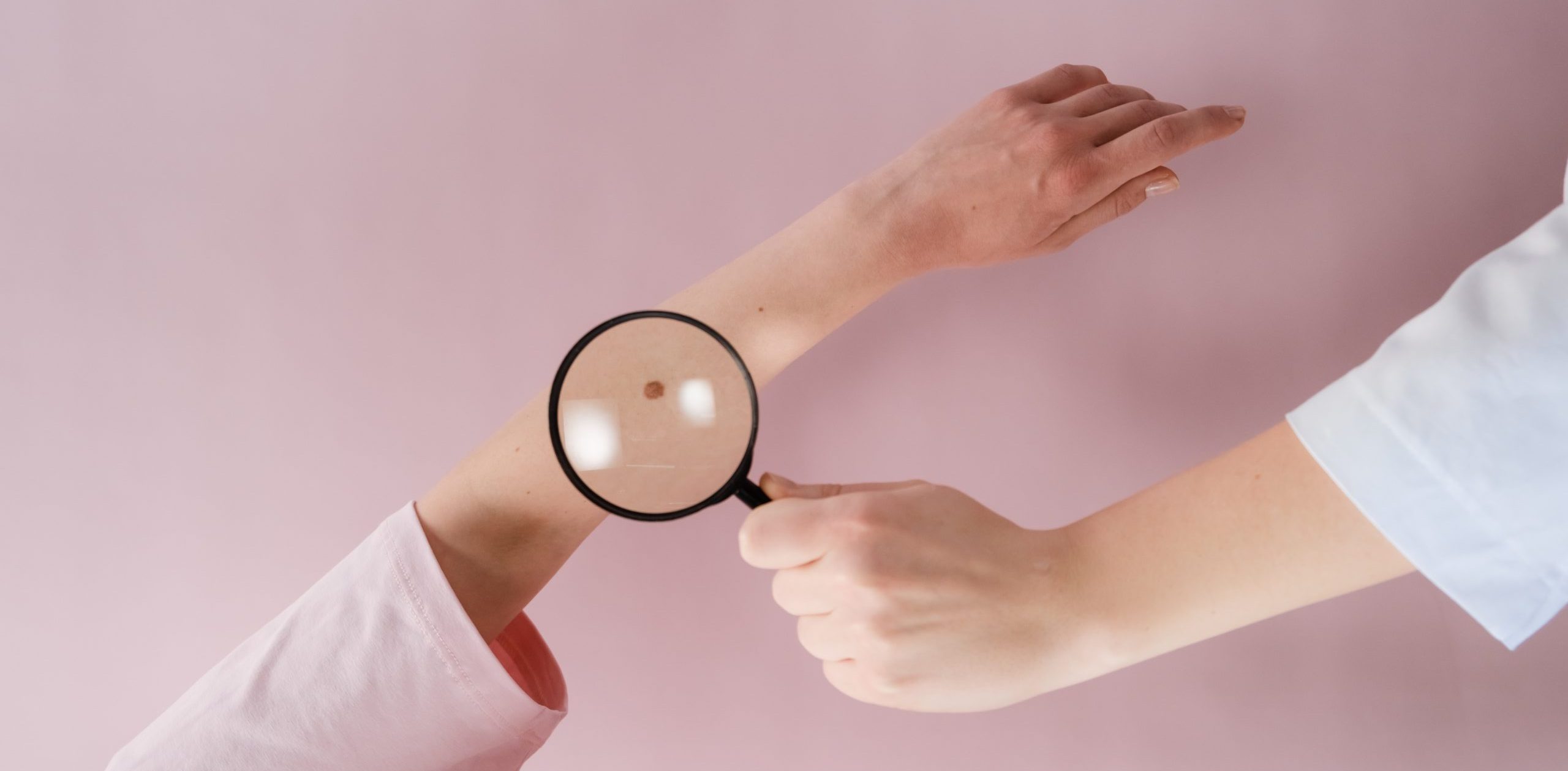 Signos de alarma para detectar el cáncer de piel y cómo prevenirlo